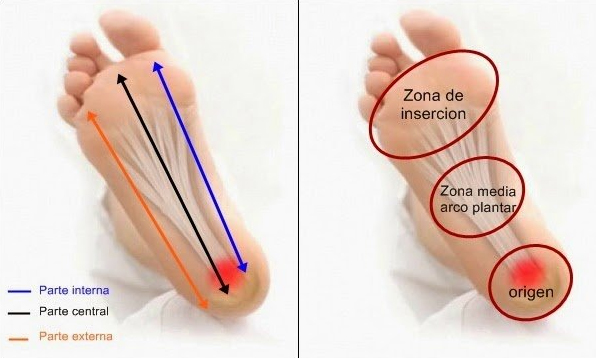 Fascitis Plantar